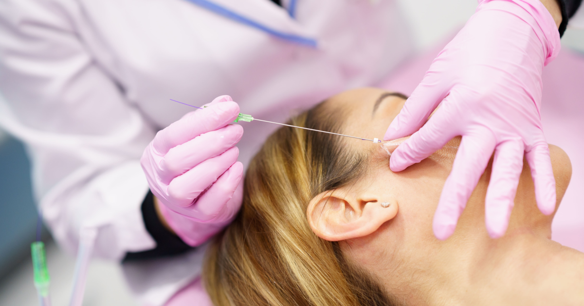 PDO threads lift procedure on woman in Johnson City, TN clinic