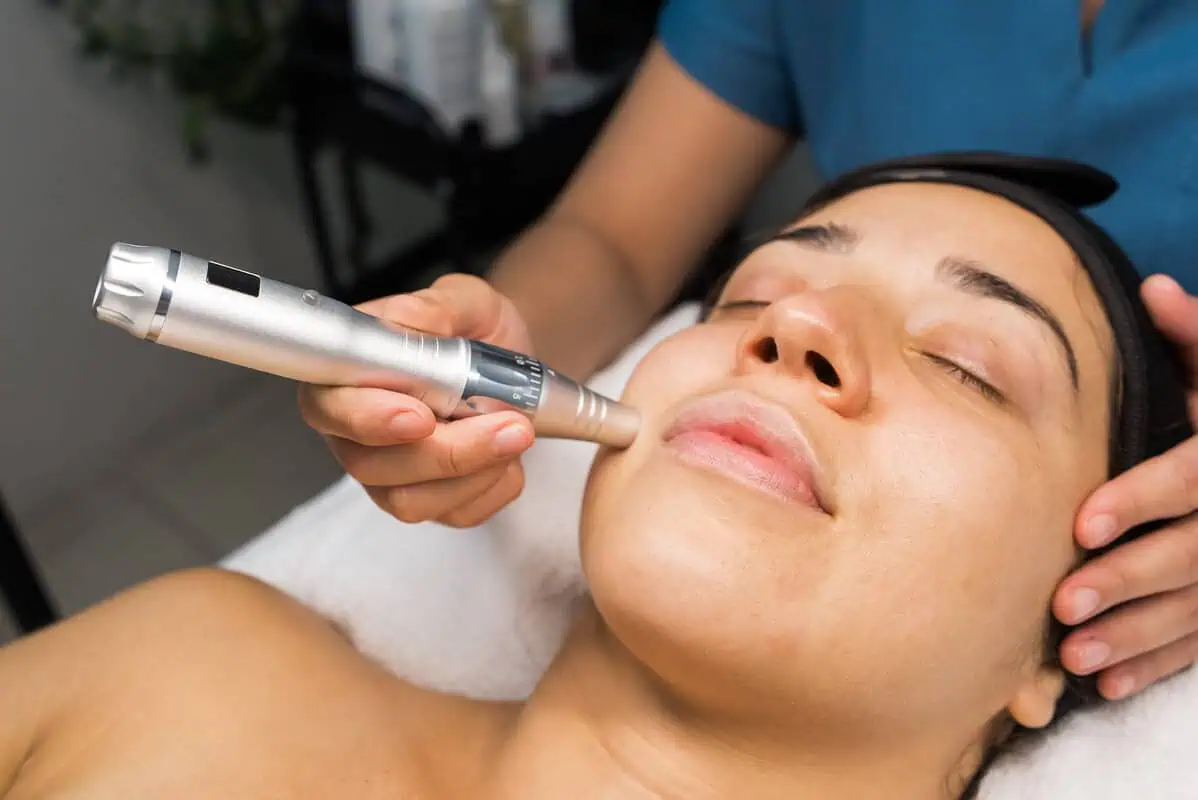 Microneedling treatment using dermapen device to improve skin texture and acne scars in Flawless Medicine clinic.