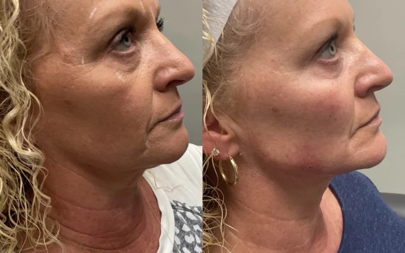 Cheek and Jaw Filler